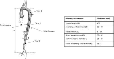 An in vitro Assessment of the Haemodynamic Features Occurring Within the True and False Lumens Separated by a Dissection Flap for a Patient-Specific Type B Aortic Dissection